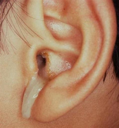 ear leaking clear fluid no pain|Otorrhea: What It Is, Causes & Treatment